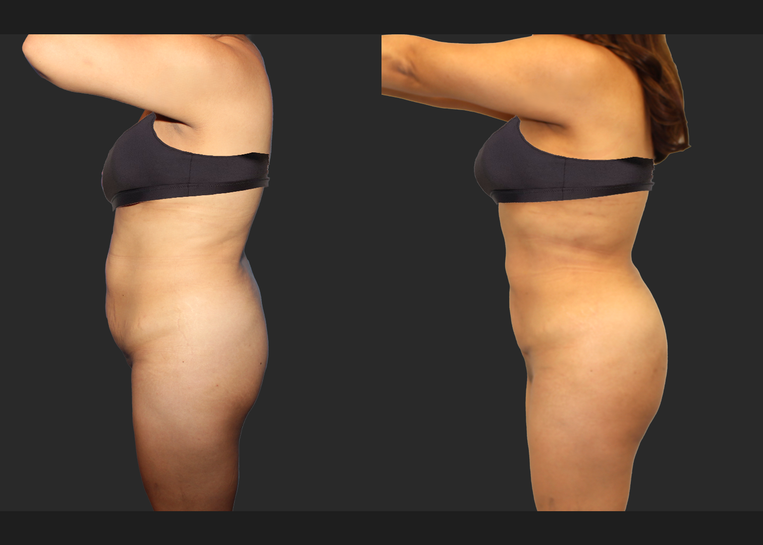 Lipo 350 Renuvion Abdomen Back BBL Fat transfer to buttock middle aged woman before after- left w bra