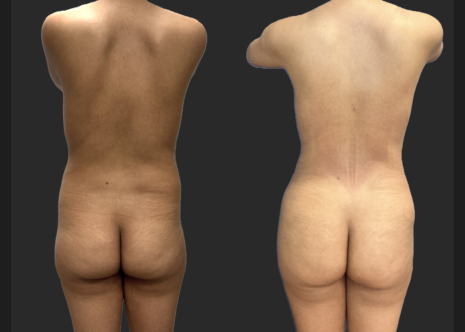 Lipo 360 Petite BBL before after- back