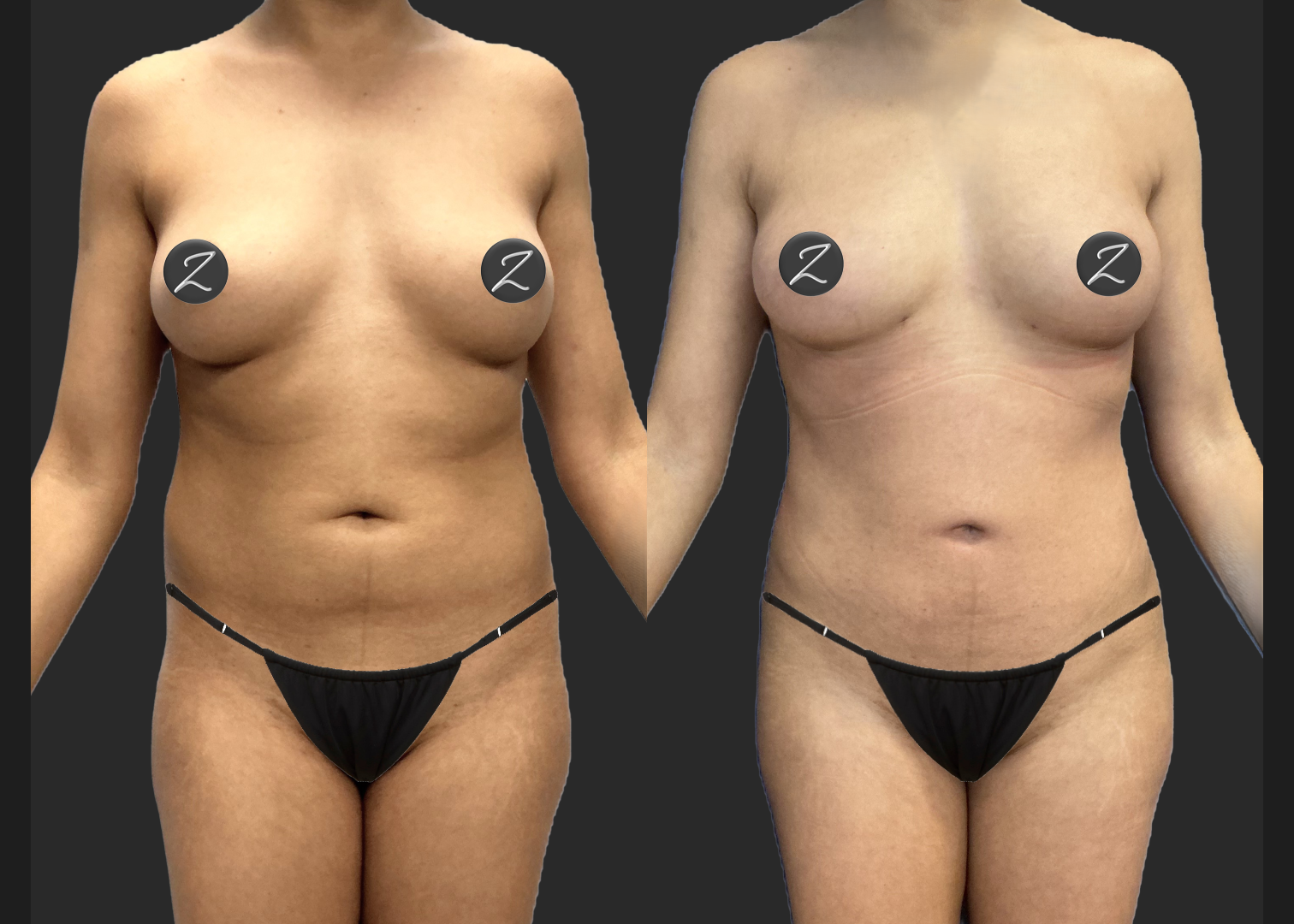 Lipo 360 Petite BBL before after- front w underwear
