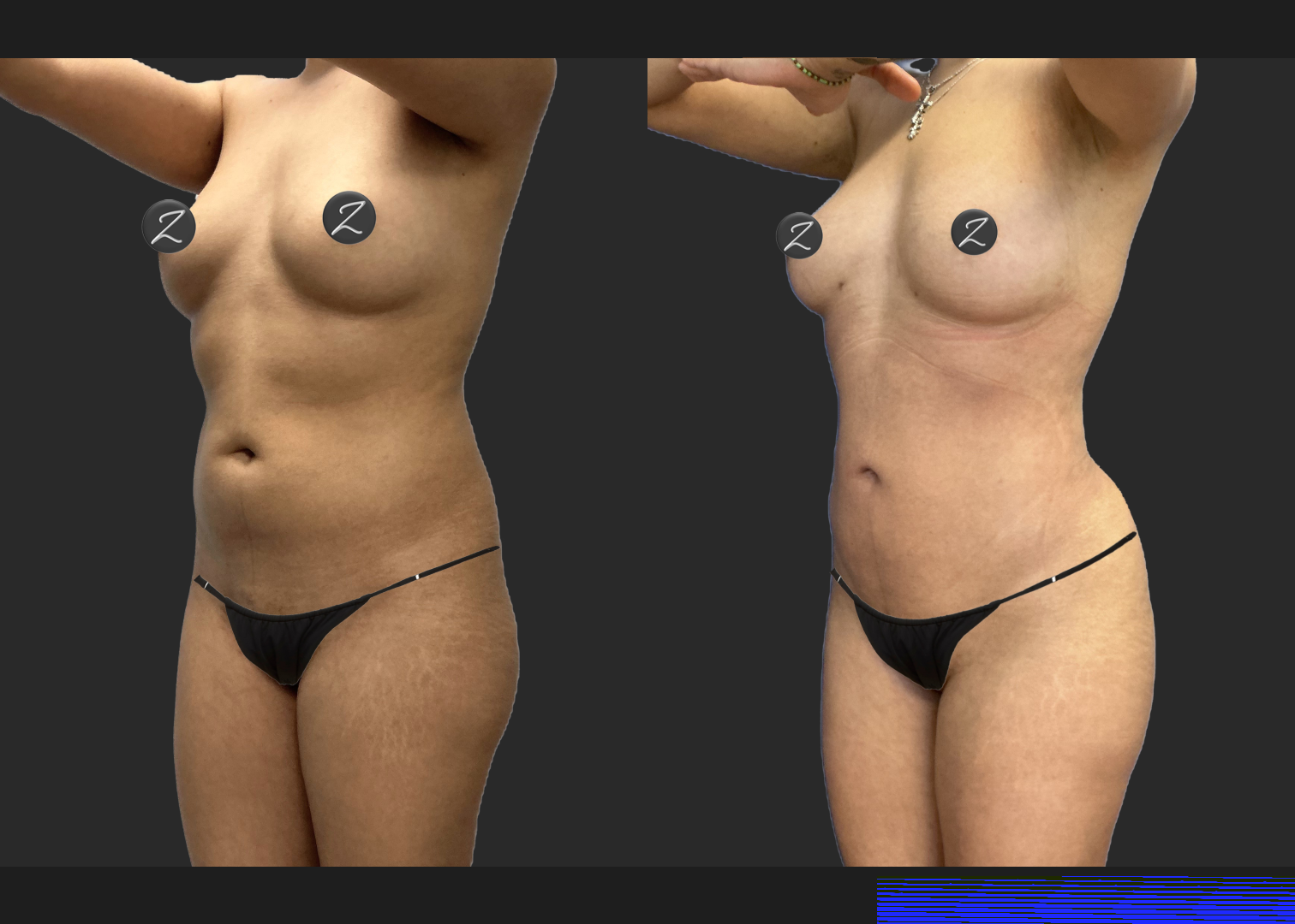 Lipo 360 Petite BBL before after- left oblique