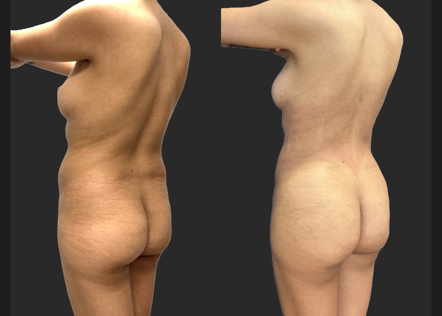 Lipo 360 Petite BBL before after- post left oblique