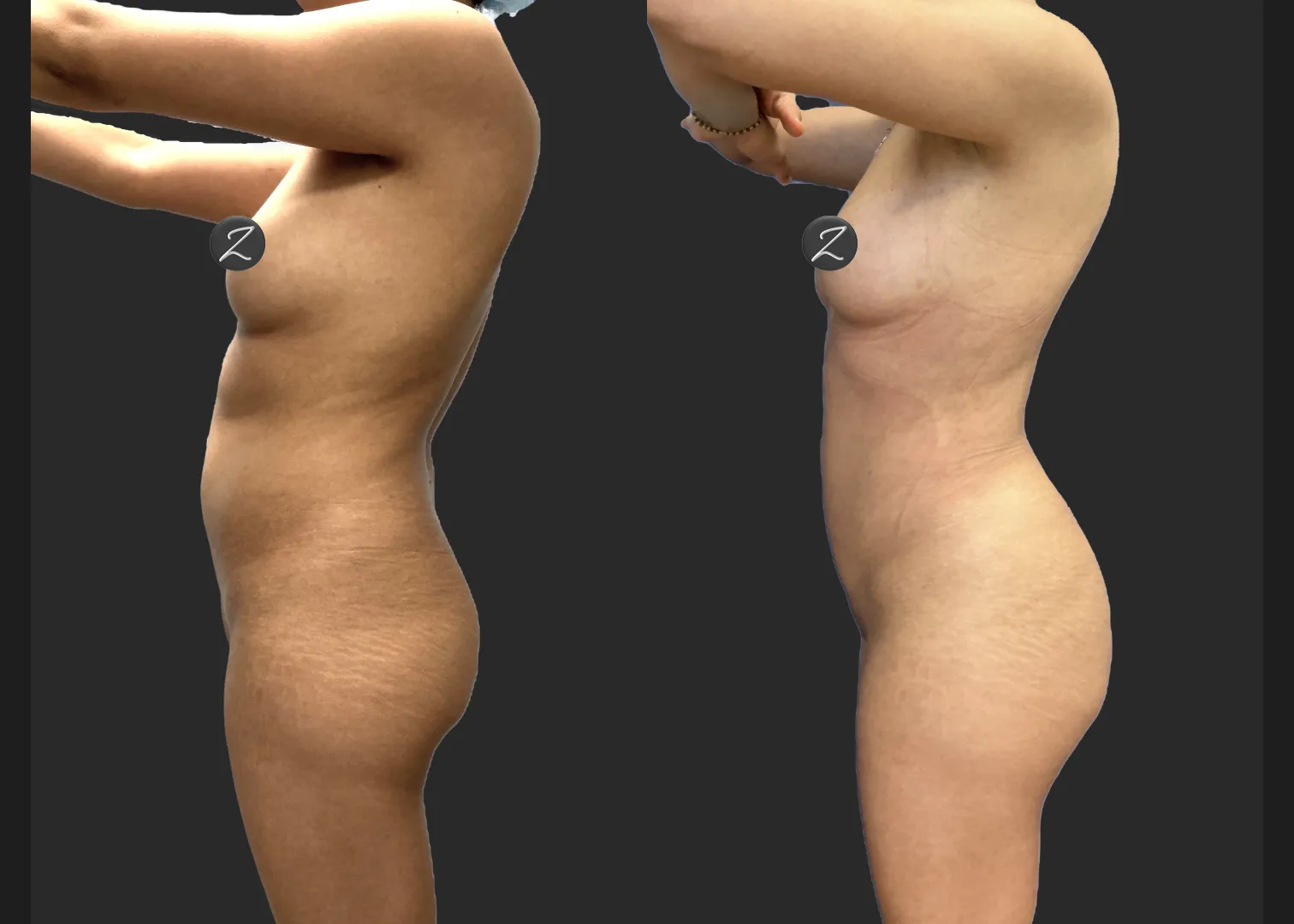 Lipo 360 Petite BBL before after w nipple cover- left