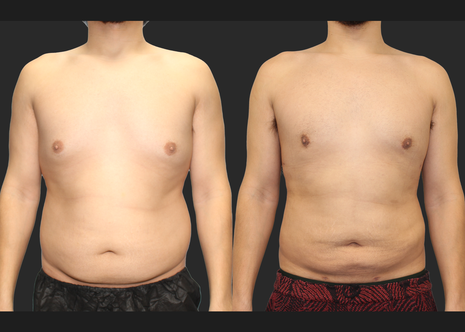 Male Massive Weightloss Lipo 360 Renuvion abdomen back chest gynecomastia before after- front