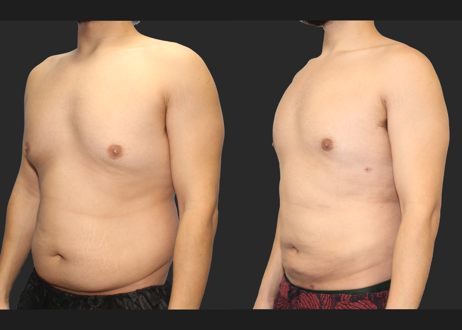 Male Massive Weightloss Lipo 360 Renuvion abdomen back chest gynecomastia before after- left oblique