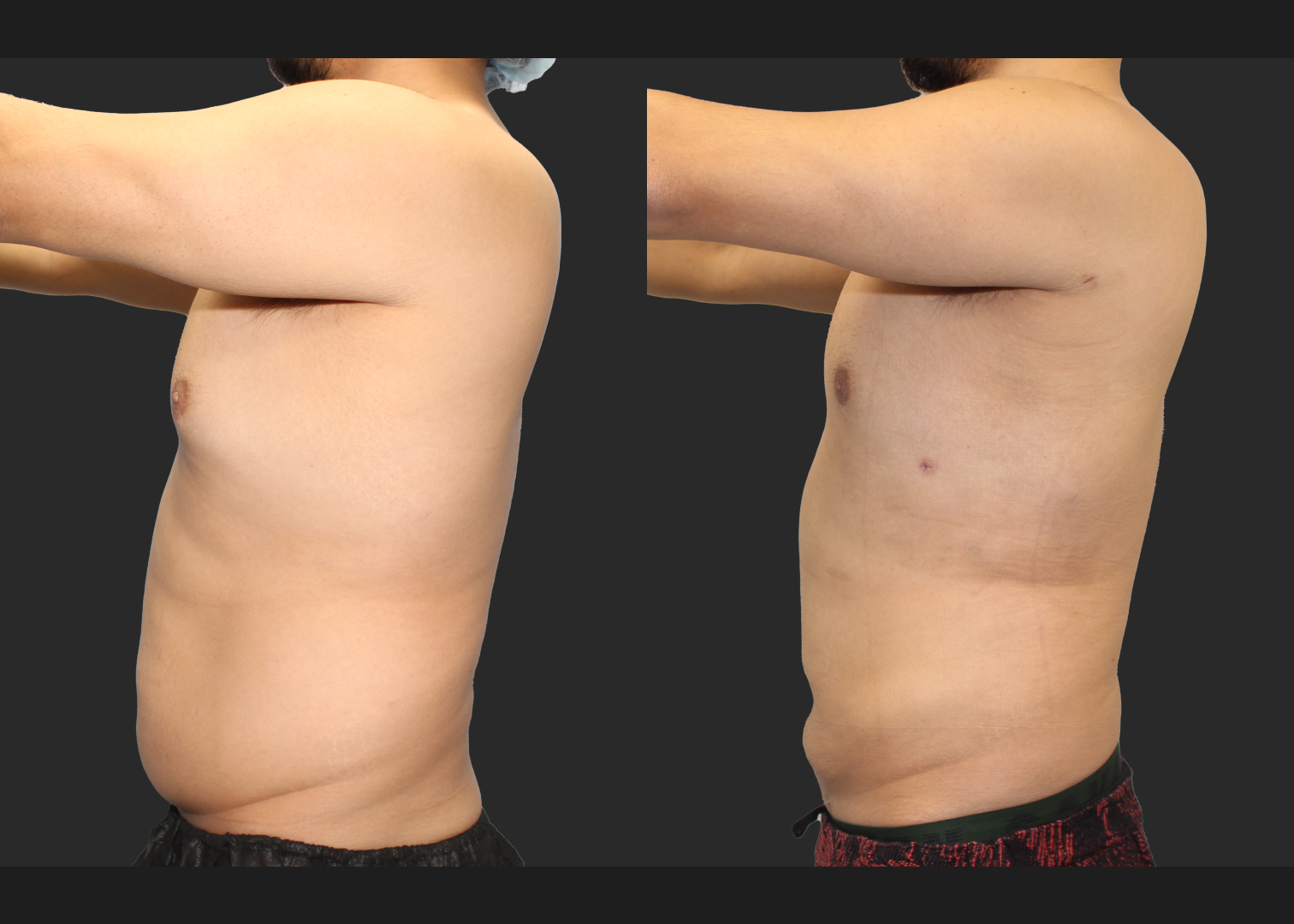 Male Massive Weightloss Lipo 360 Renuvion abdomen back chest gynecomastia before after- left