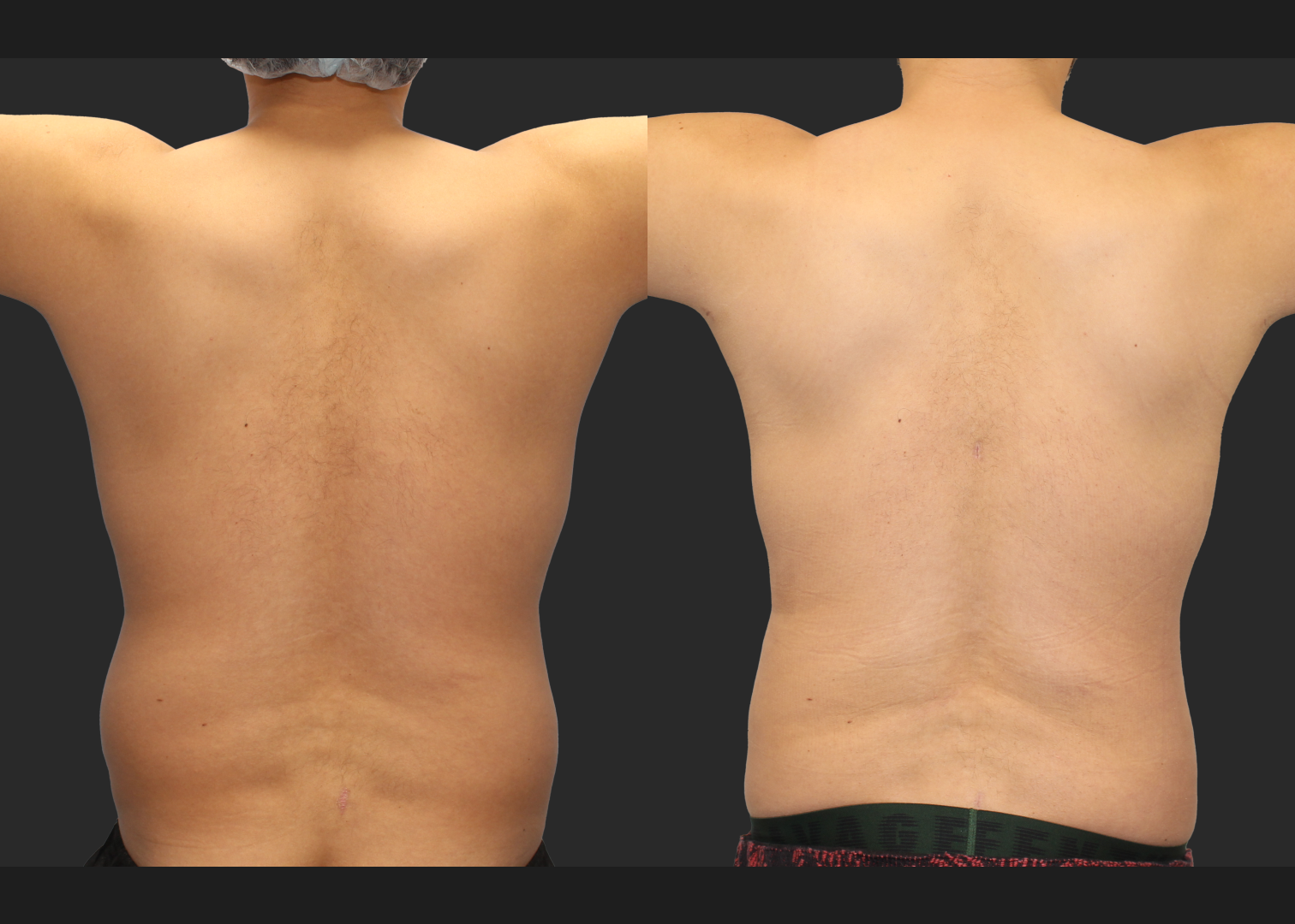 Male Massive Weightloss Lipo 360 Renuvion abdomen back chest gynecomastia before after- post arms up