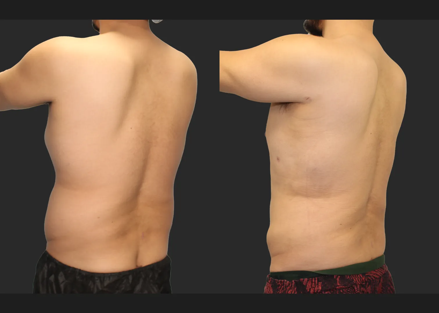 Male Massive Weightloss Lipo 360 Renuvion abdomen back chest gynecomastia before after- post left oblique