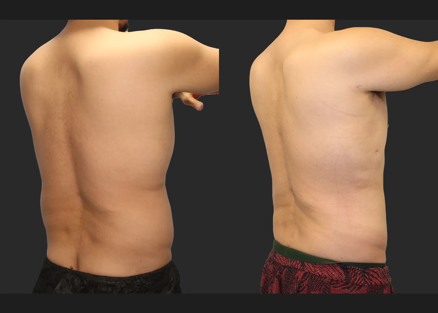 Male Massive Weightloss Lipo 360 Renuvion abdomen back chest gynecomastia before after- post right oblique