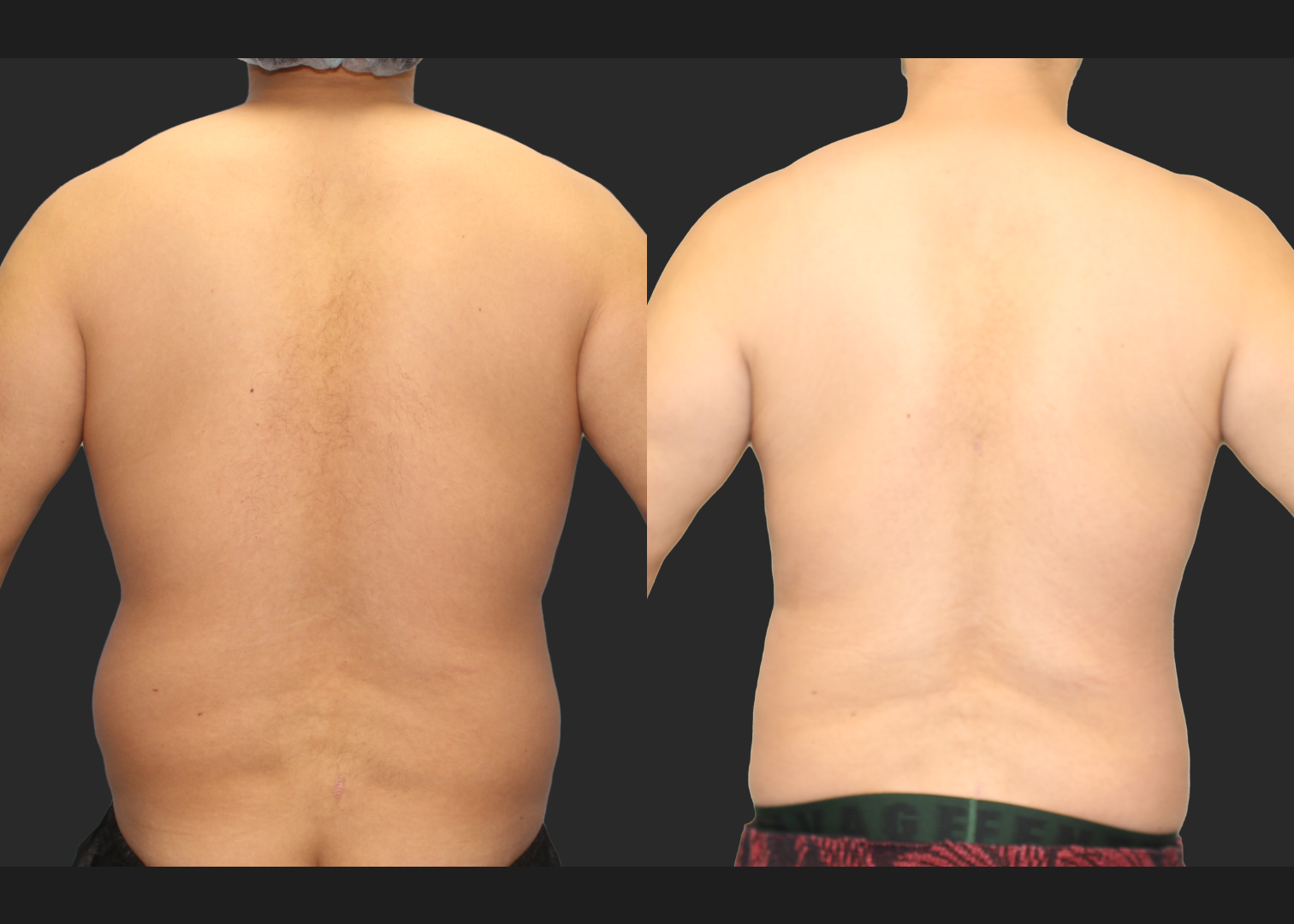 Male Massive Weightloss Lipo 360 Renuvion abdomen back chest gynecomastia before after- post