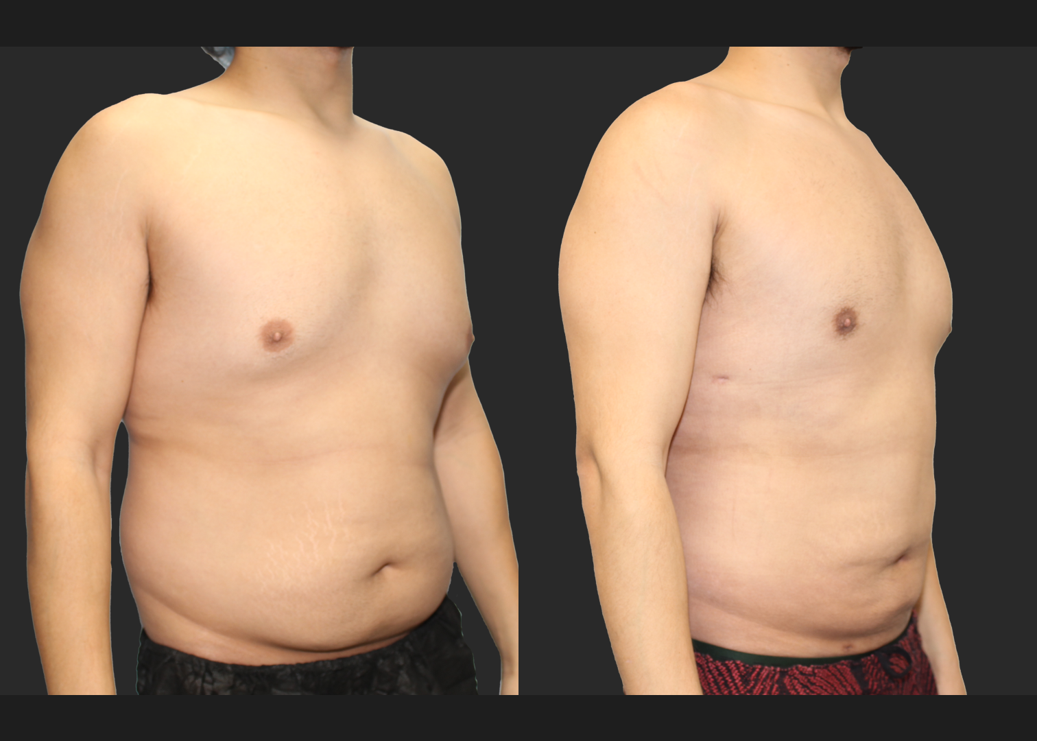 Male Massive Weightloss Lipo 360 Renuvion abdomen back chest gynecomastia before after- right oblique