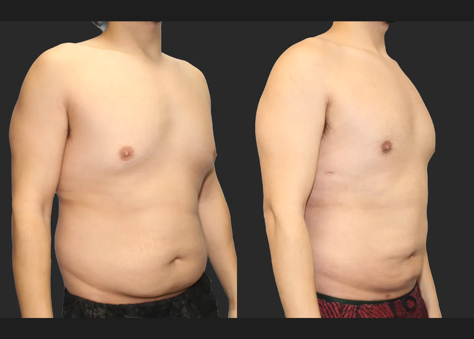 Male Massive Weightloss Lipo 360 Renuvion abdomen back chest gynecomastia before after- right oblique