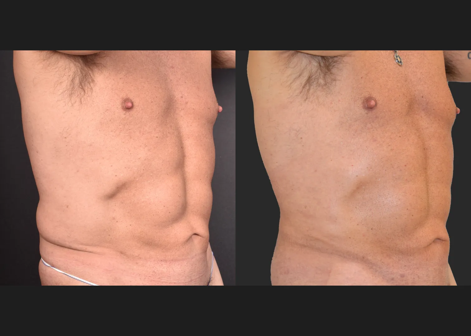 Male flank liposuction abdomen and lower back renuvion before after- ant right oblique