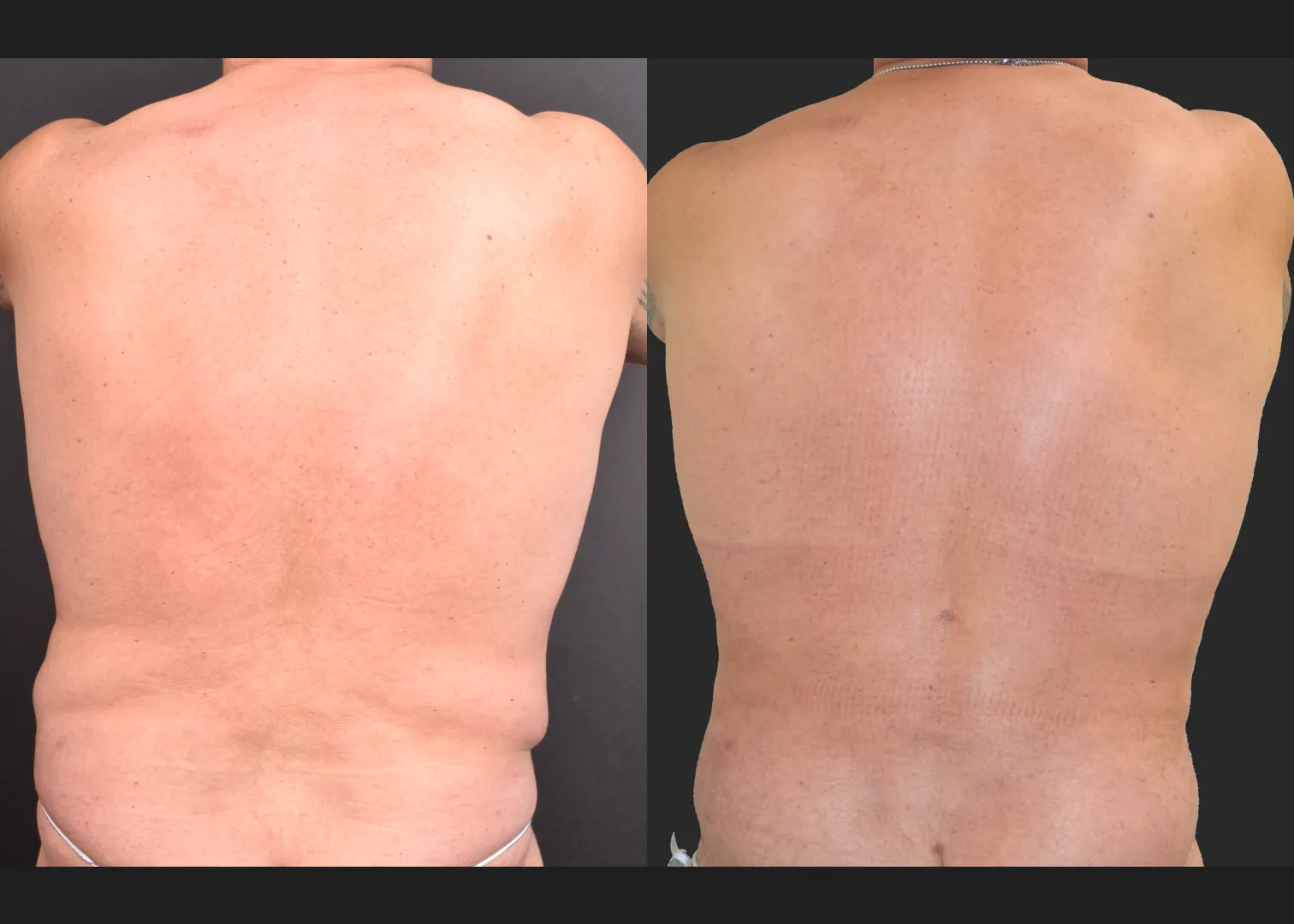 Male flank liposuction abdomen and lower back renuvion before after- back arms fwd