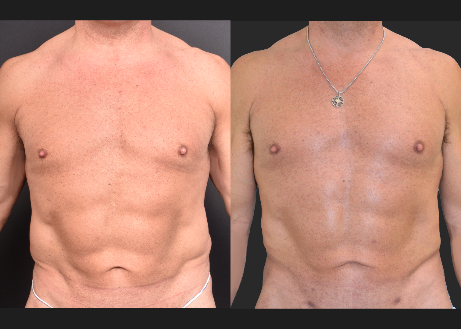 Male flank liposuction abdomen and lower back renuvion before after- front