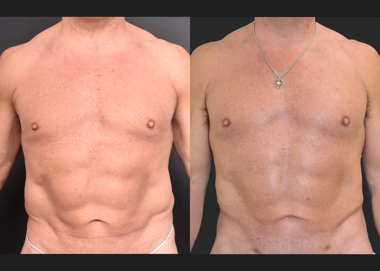 Male flank liposuction abdomen and lower back renuvion before after- front