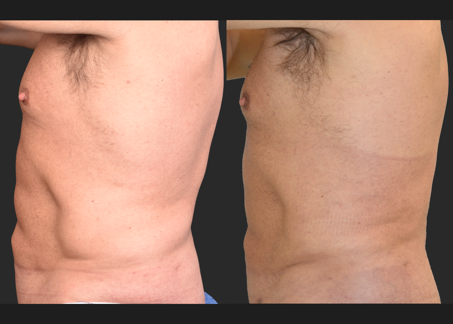 Male flank liposuction abdomen and lower back renuvion before after- left