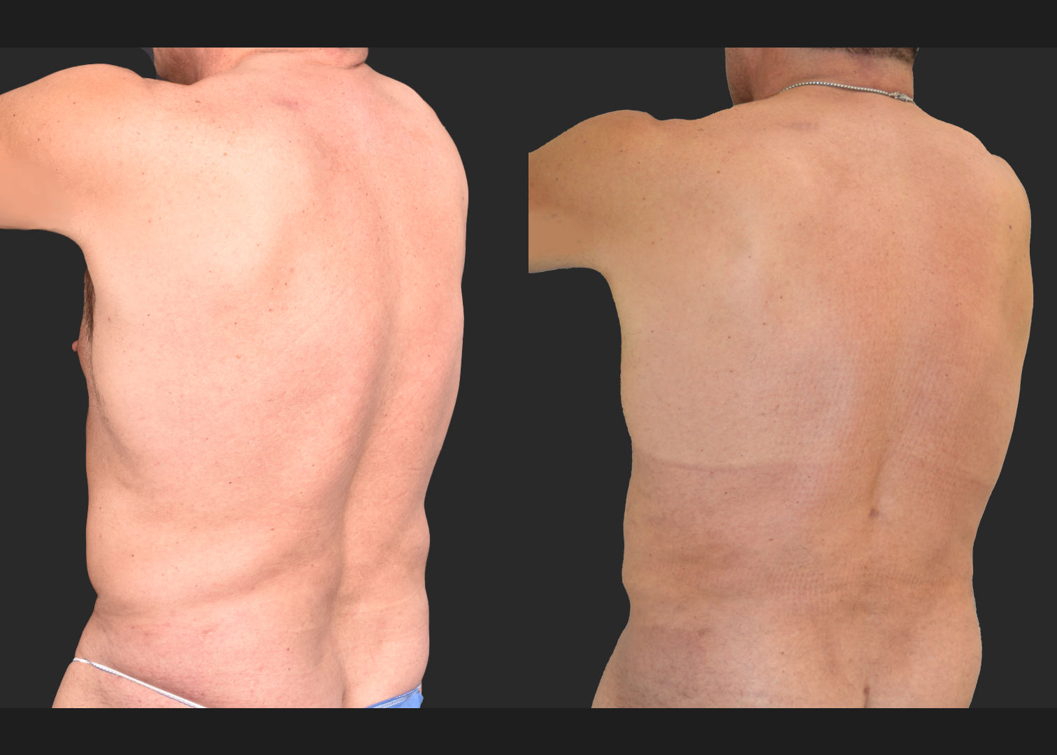 Male flank liposuction abdomen and lower back renuvion before after- post left oblique
