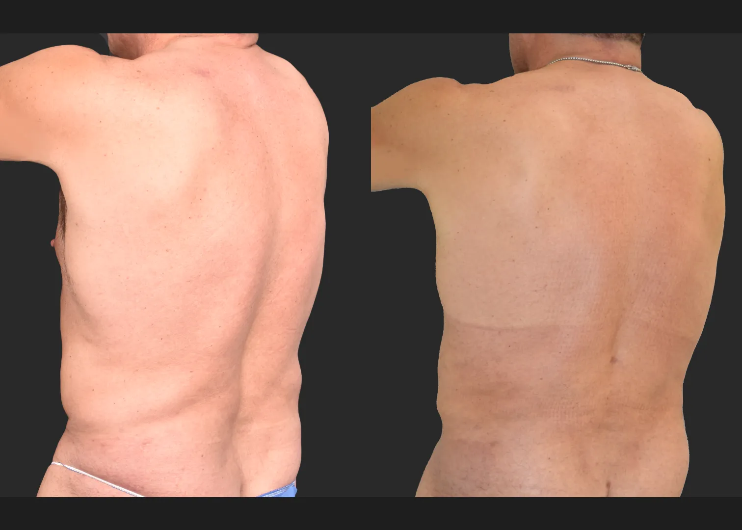 Male flank liposuction abdomen and lower back renuvion before after- post left oblique