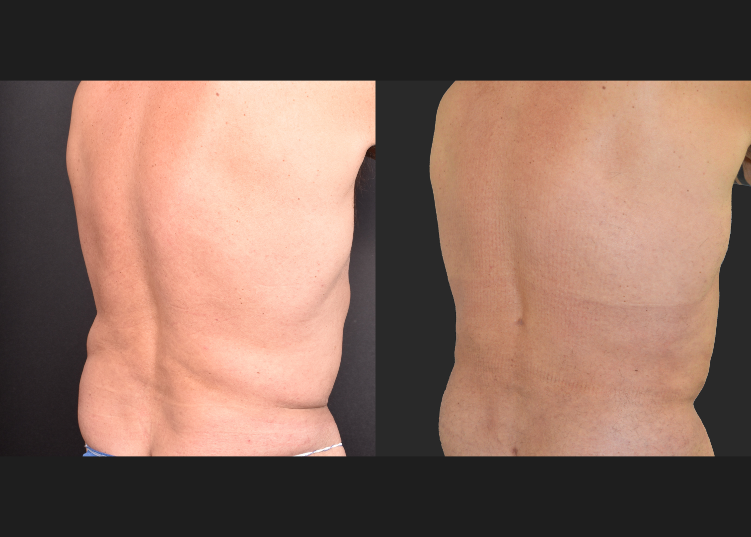 Male flank liposuction abdomen and lower back renuvion before after- post right oblique