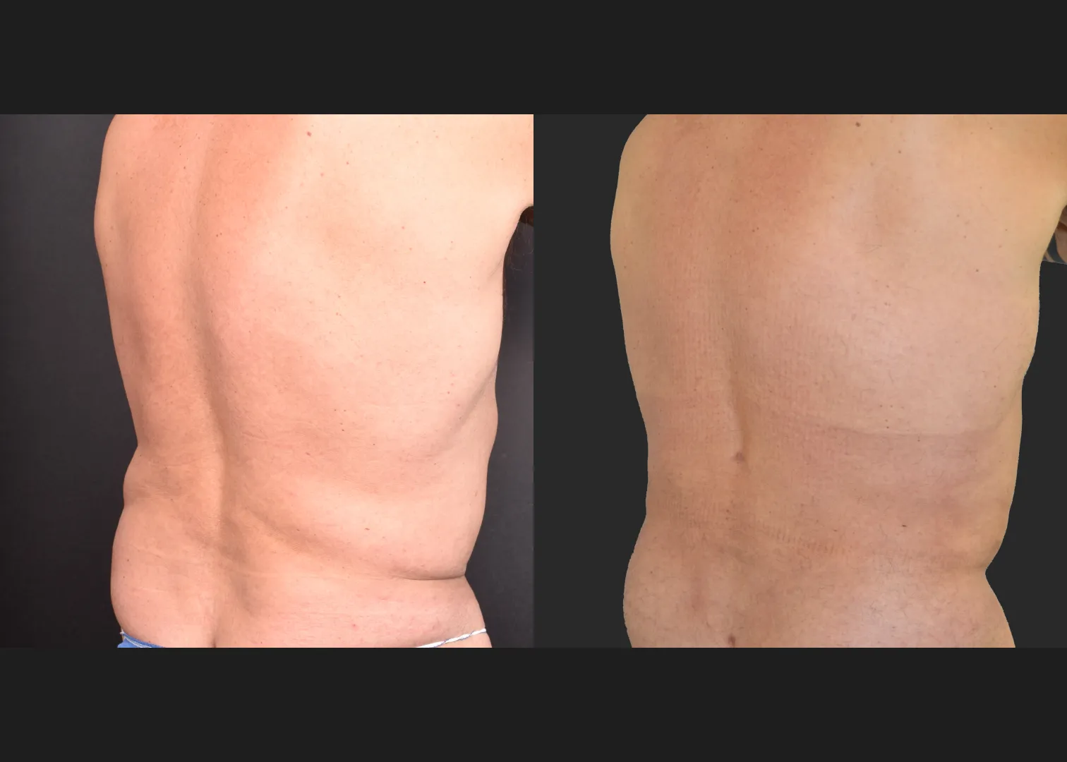 Male flank liposuction abdomen and lower back renuvion before after- post right oblique
