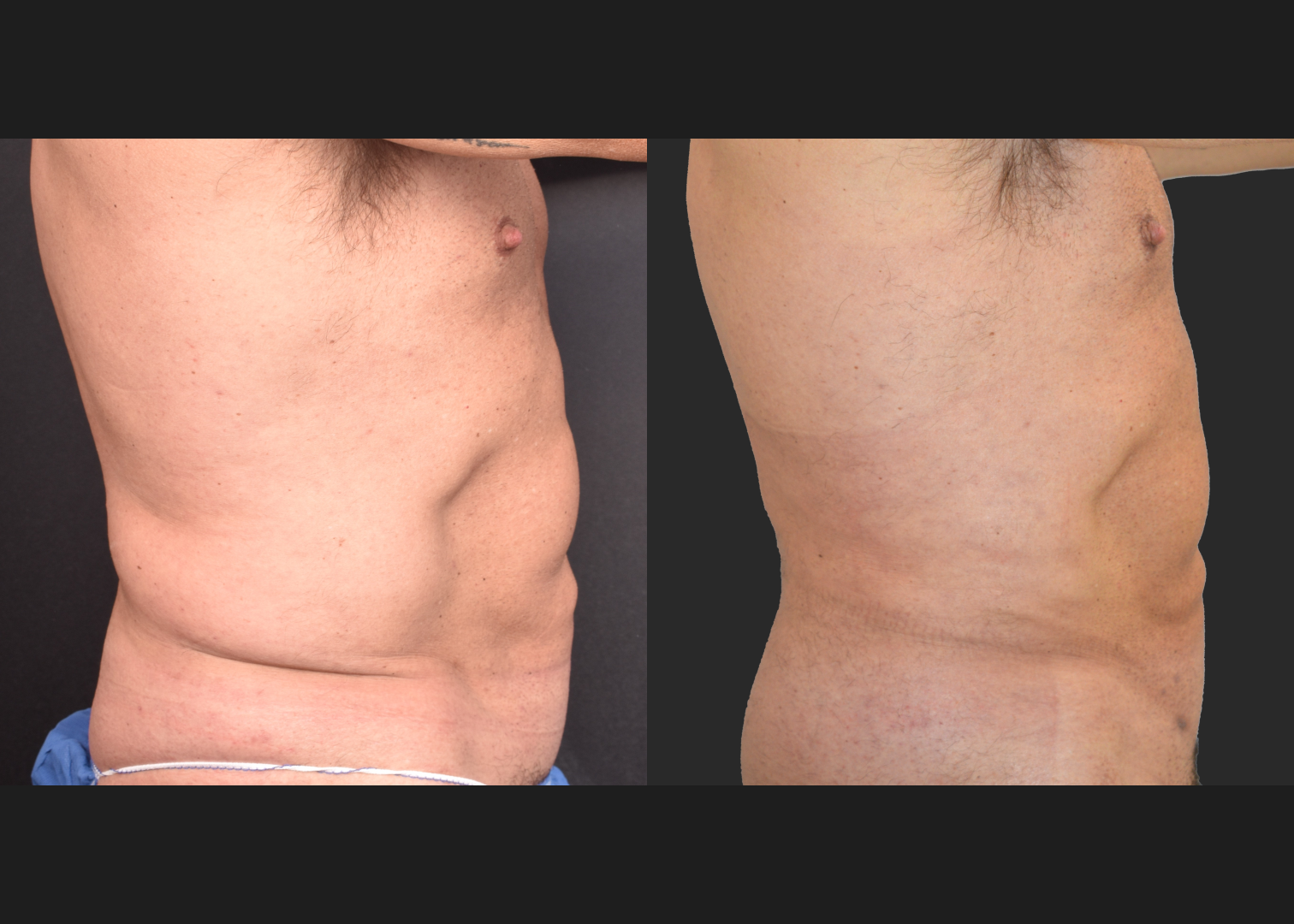 Male flank liposuction abdomen and lower back renuvion before after- right