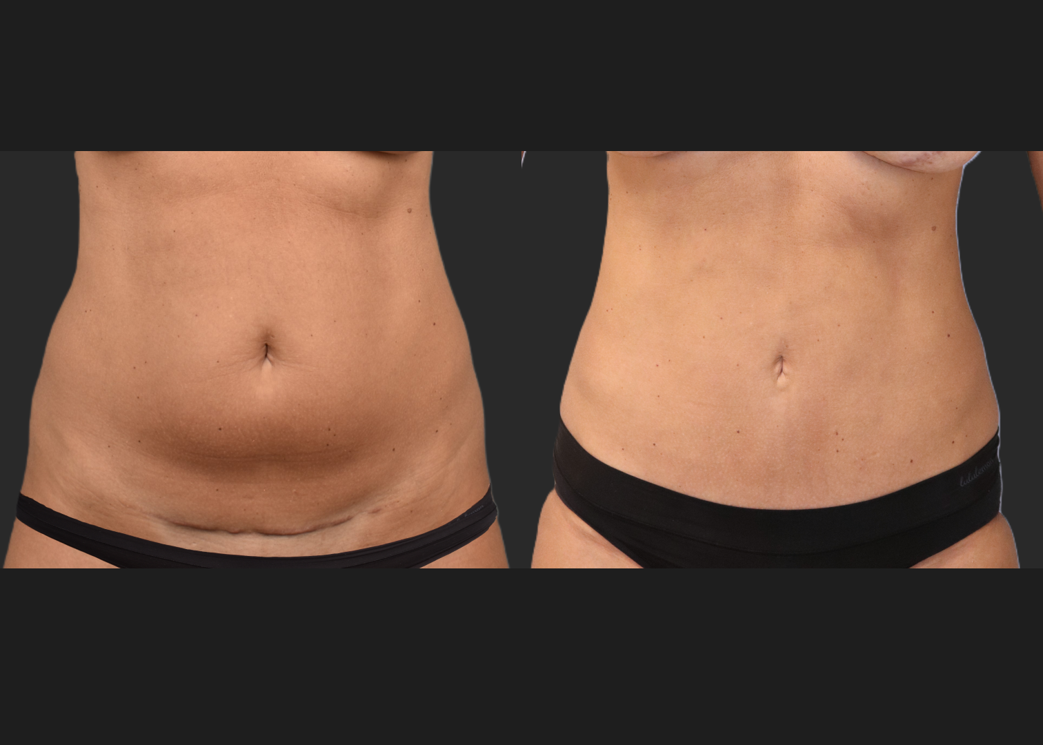 Mini Abdomminoplasty tummy tuck stomach liposuction renuvion c-section scar revision before after- front 2