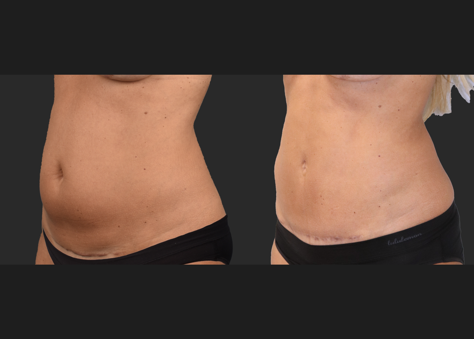 Mini Abdomminoplasty tummy tuck stomach liposuction renuvion c-section scar revision before after- left oblique