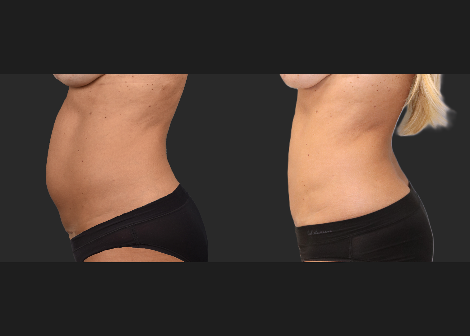 Mini Abdomminoplasty tummy tuck stomach liposuction renuvion c-section scar revision before after- left