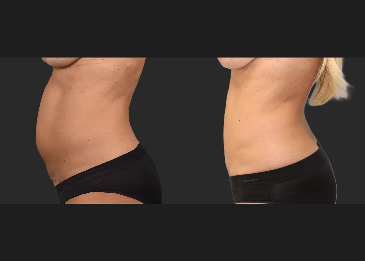 Mini Abdomminoplasty tummy tuck stomach liposuction renuvion c-section scar revision before after- left