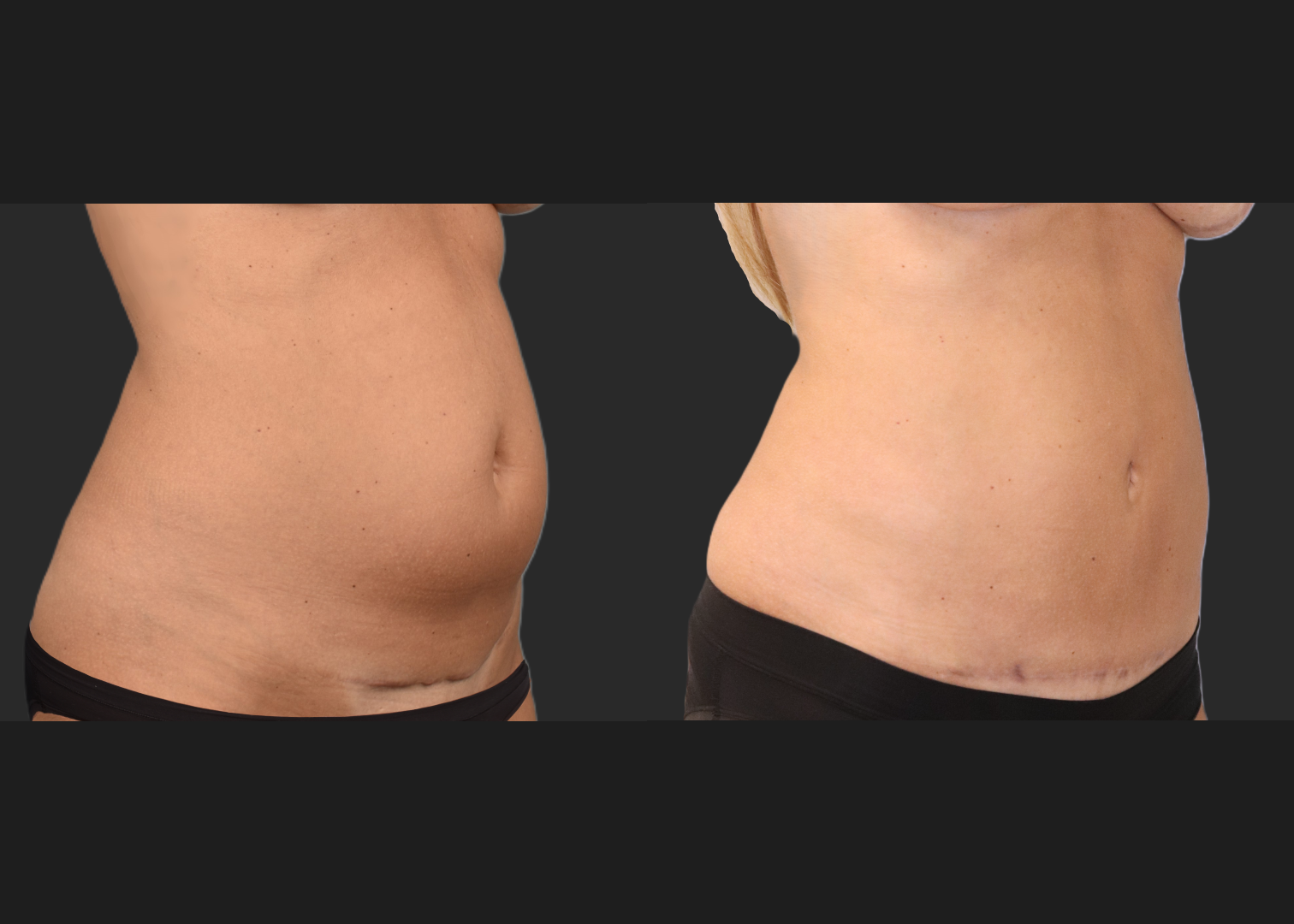 Mini Abdomminoplasty tummy tuck stomach liposuction renuvion c-section scar revision before after- right oblique