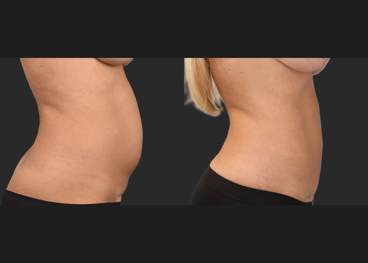 Mini Abdomminoplasty tummy tuck stomach liposuction renuvion c-section scar revision before after- right