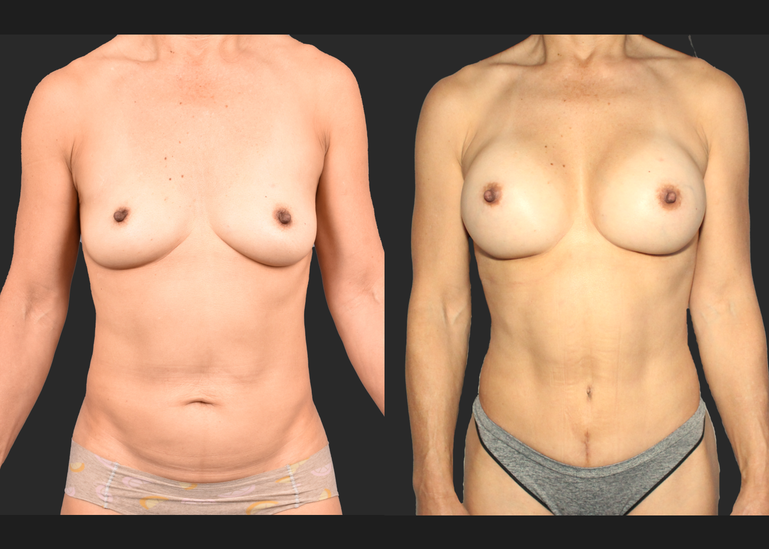 Mommy Makoever Breast Aug Abdominoplasty Rectus Diastasis Repair Renuvion Abdomen Before After- Front