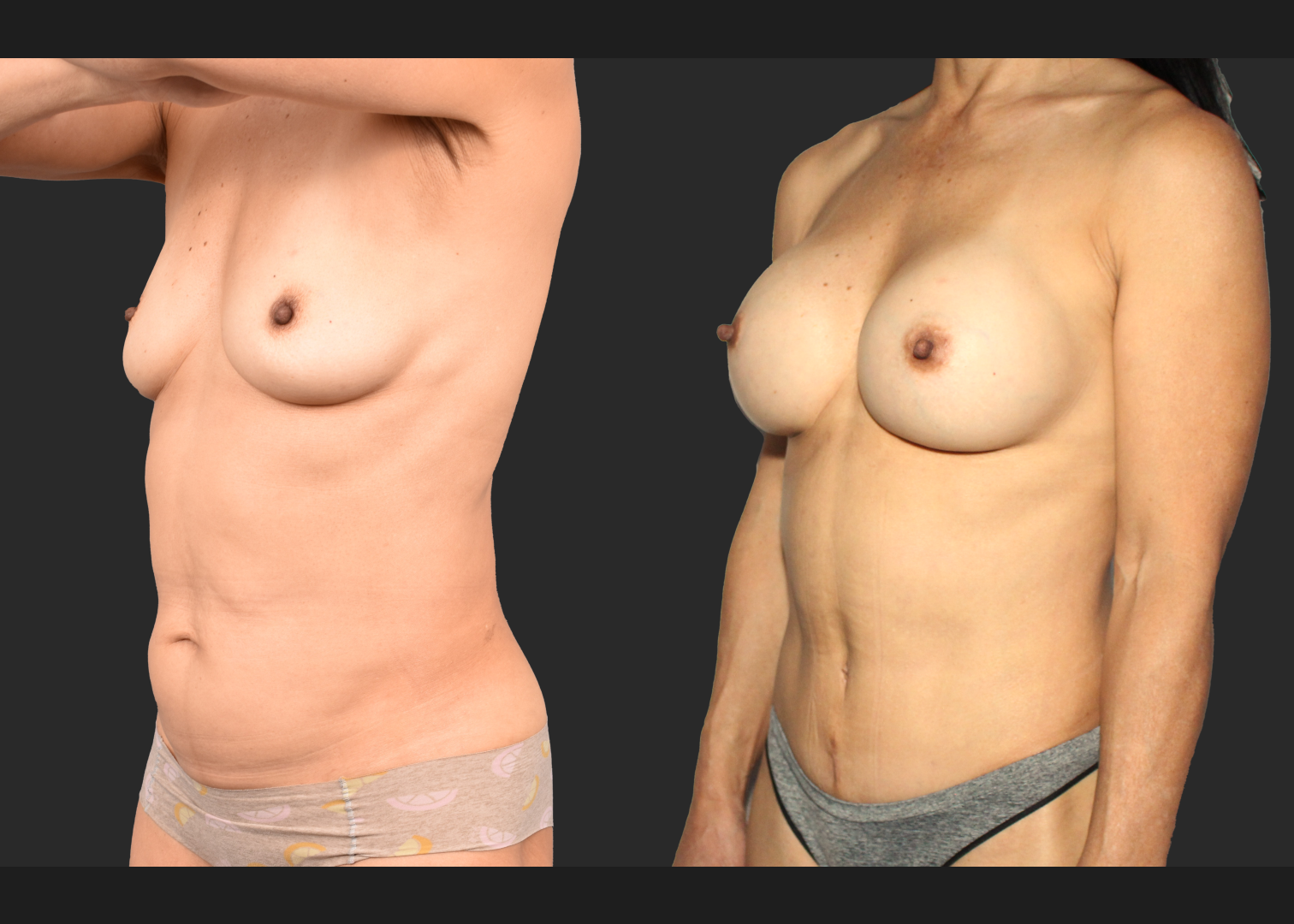 Mommy Makoever Breast Aug Abdominoplasty Rectus Diastasis Repair Renuvion Abdomen Before After- left oblique