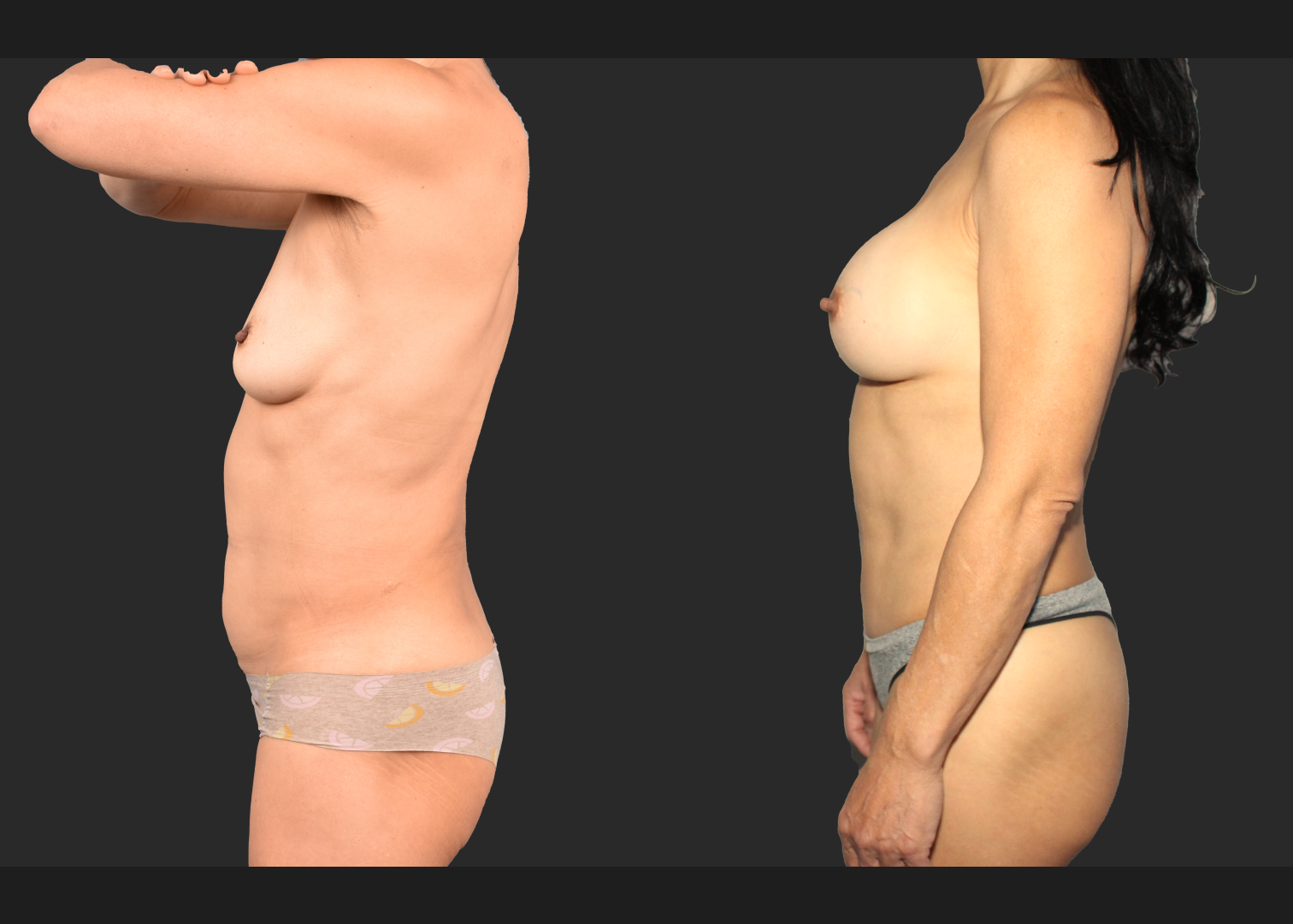 Mommy Makoever Breast Aug Abdominoplasty Rectus Diastasis Repair Renuvion Abdomen Before After- left