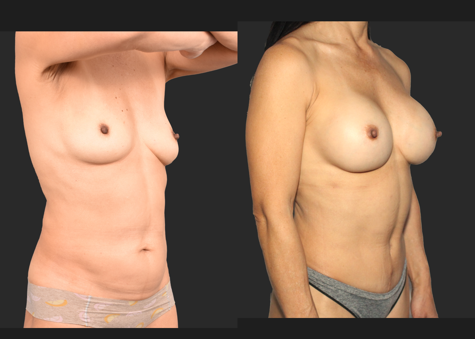 Mommy Makoever Breast Aug Abdominoplasty Rectus Diastasis Repair Renuvion Abdomen Before After- right oblique