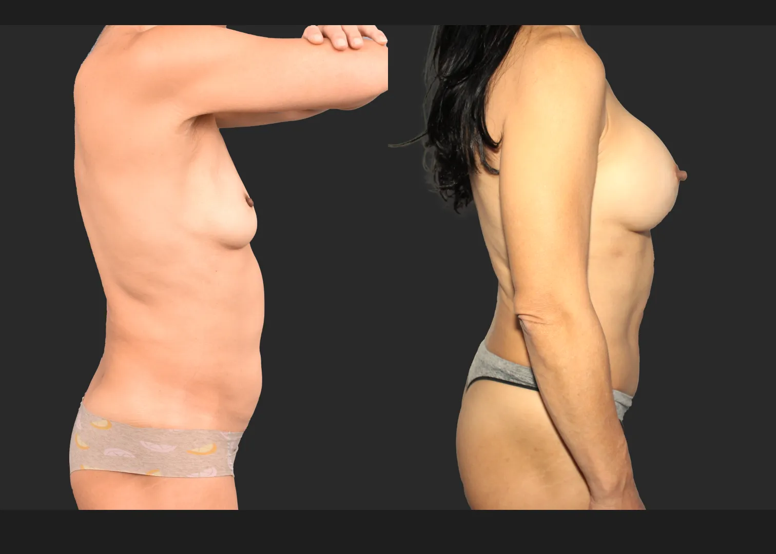 Mommy Makoever Breast Aug Abdominoplasty Rectus Diastasis Repair Renuvion Abdomen Before After- right