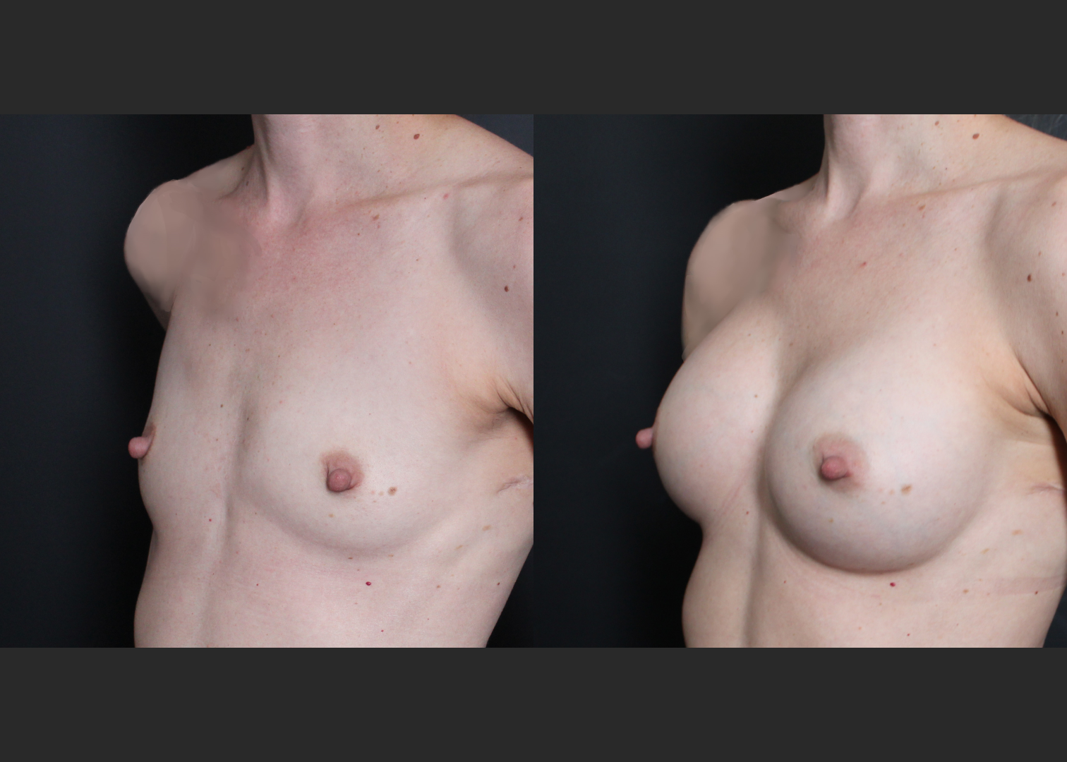 Petite small breast augmentation Sientra HSC+ smooth round moderate profile silicone gel gummy bear implants 250 cc subpectoral dual plane before after- left oblique