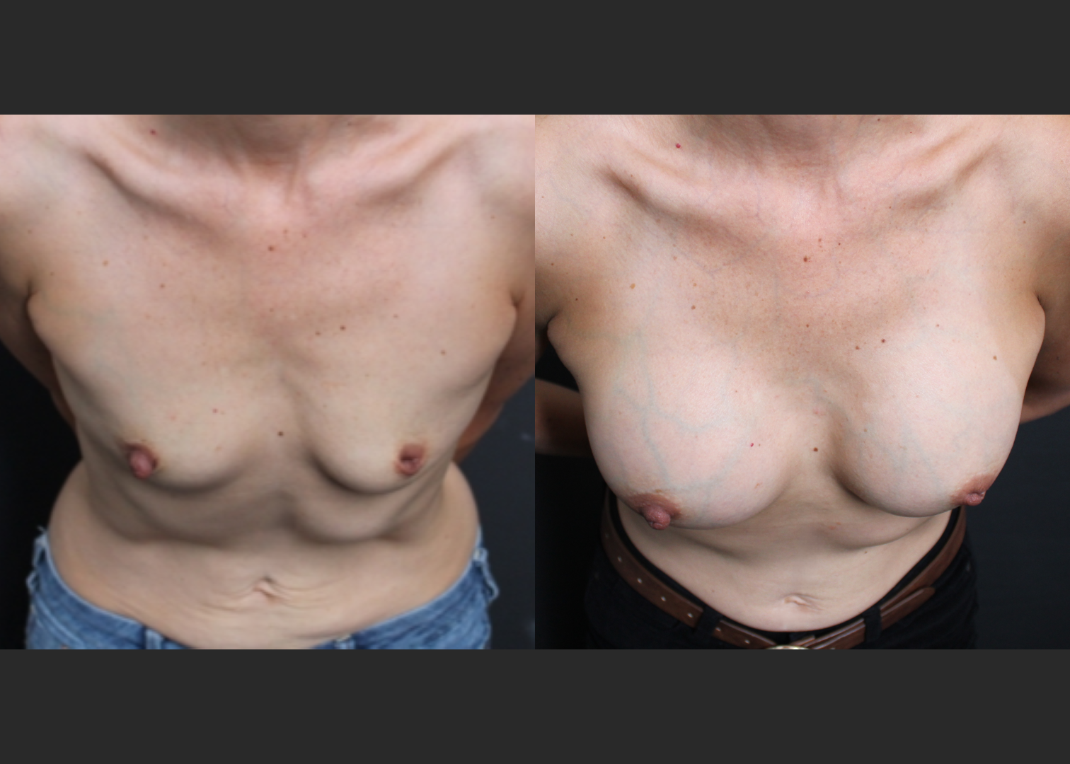 Petite small breast augmentation Sientra HSC+ smooth round moderate profile silicone gel gummy bear implants 270 cc subpectoral dual plane before after- cleavage