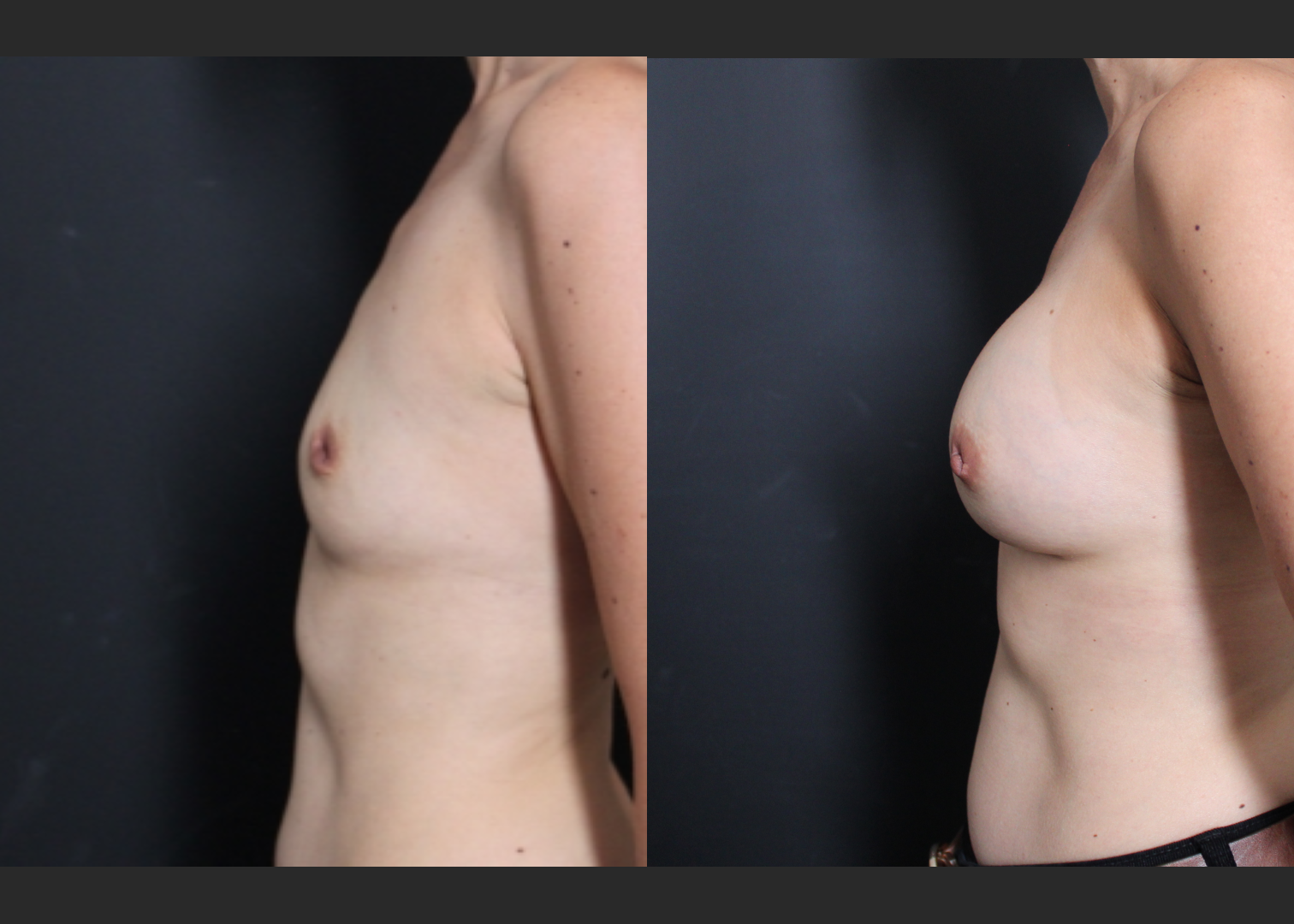 Petite small breast augmentation Sientra HSC+ smooth round moderate profile silicone gel gummy bear implants 270 cc subpectoral dual plane before after- left