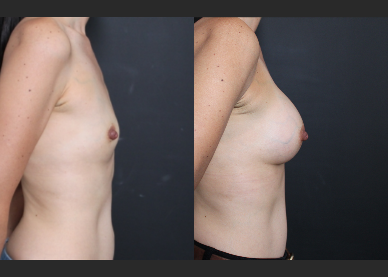 Petite small breast augmentation Sientra HSC+ smooth round moderate profile silicone gel gummy bear implants 270 cc subpectoral dual plane before after- right