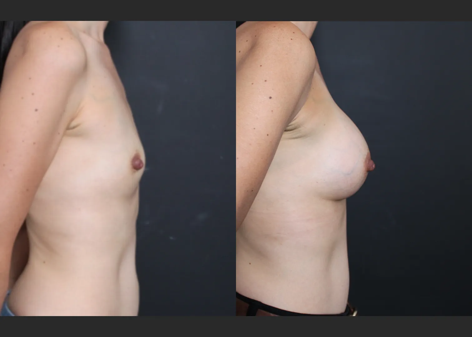 Petite small breast augmentation Sientra HSC+ smooth round moderate profile silicone gel gummy bear implants 270 cc subpectoral dual plane before after- right