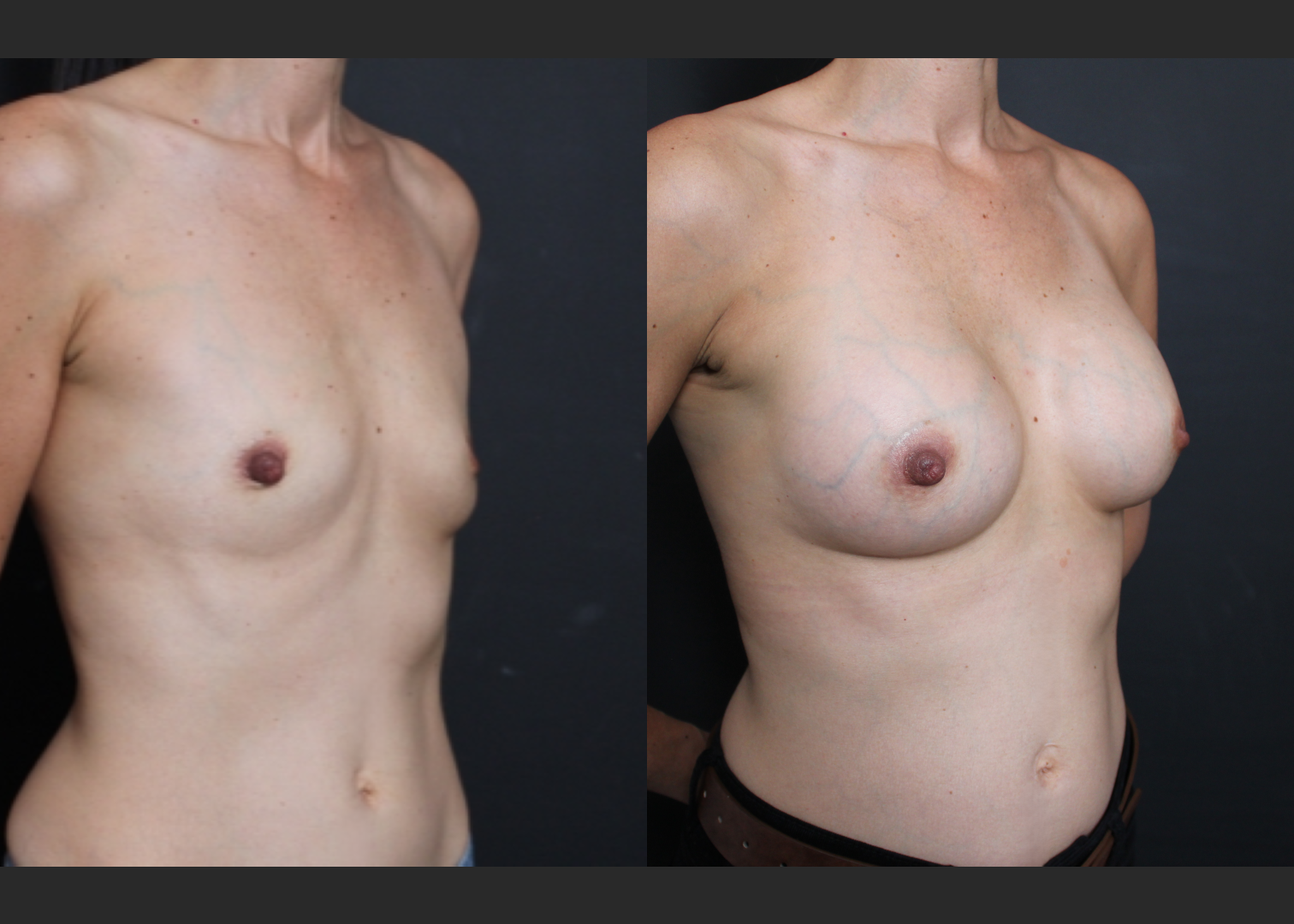 Petite small breast augmentation Sientra HSC+ smooth round moderate profile silicone gel gummy bear implants 270 cc subpectoral dual plane before after- rightoblique