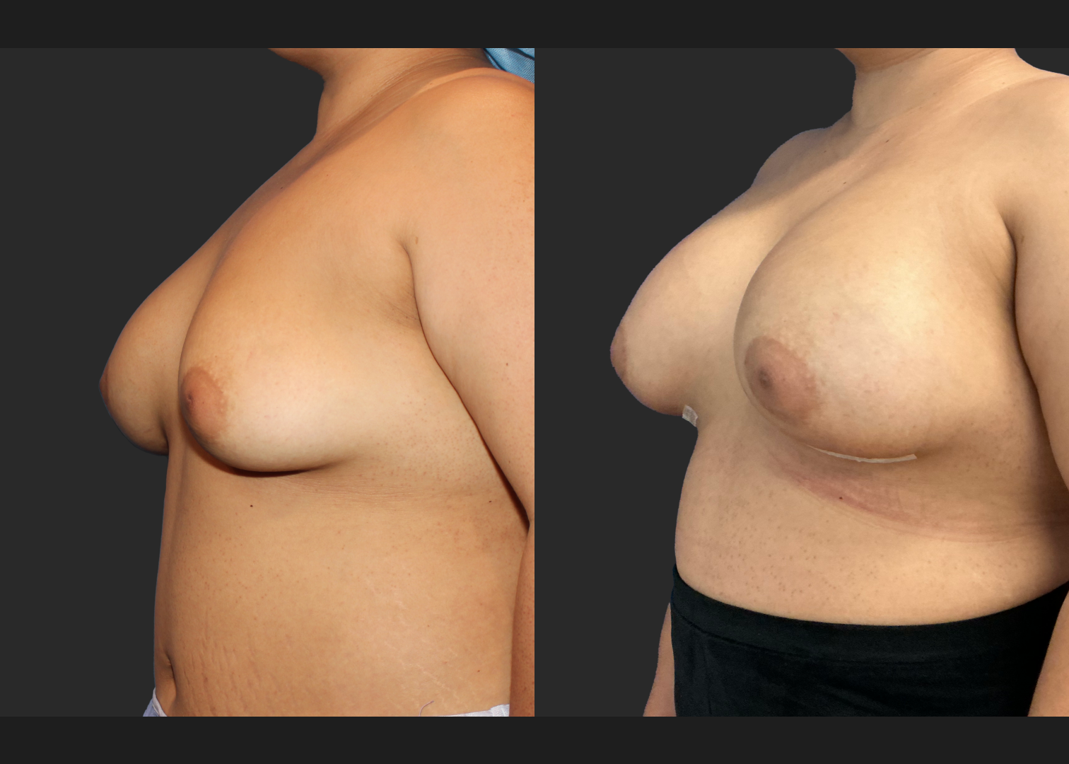 Remove replace delated saline implants before after- left oblique