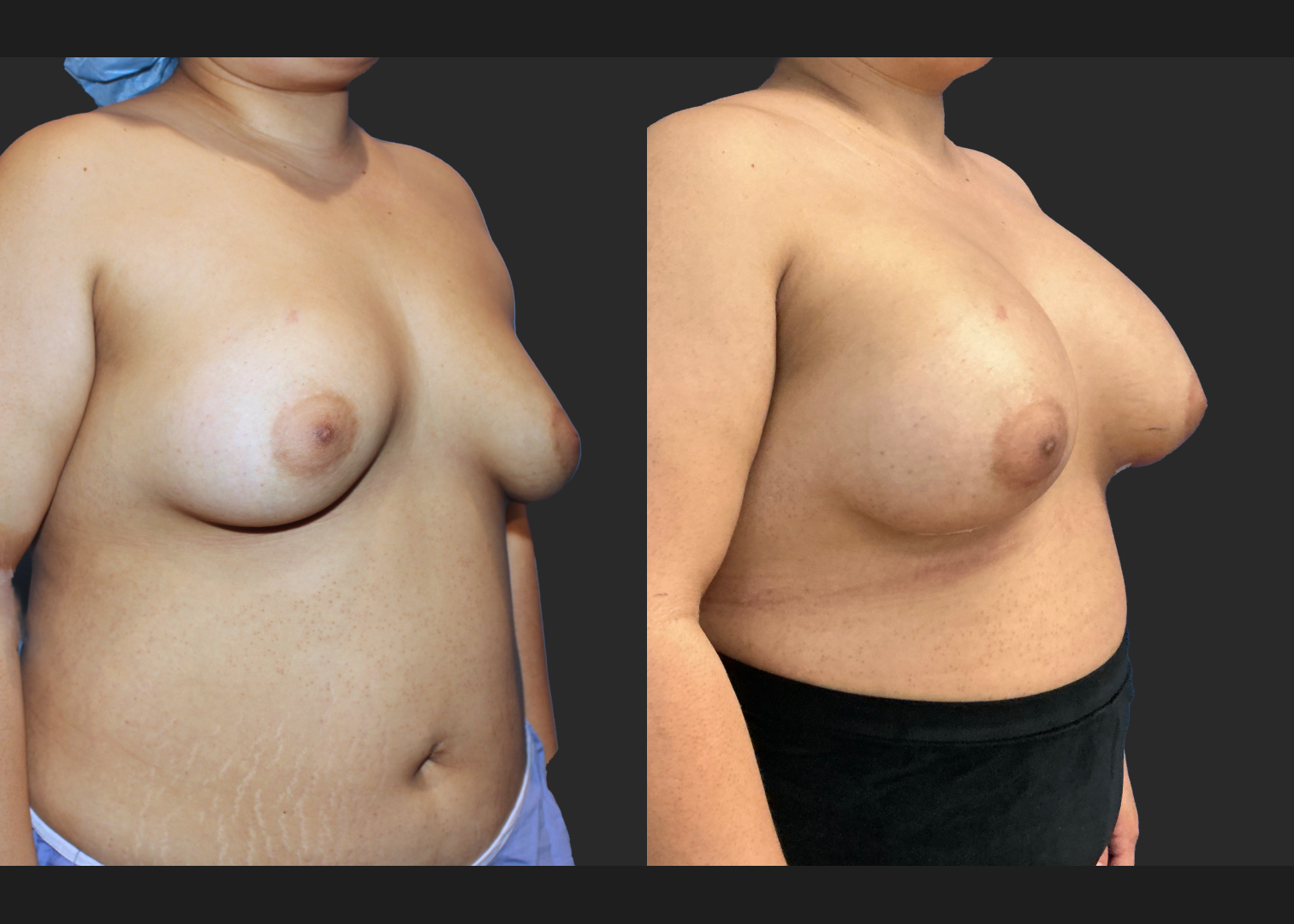 Remove replace delated saline implants before after- right oblique