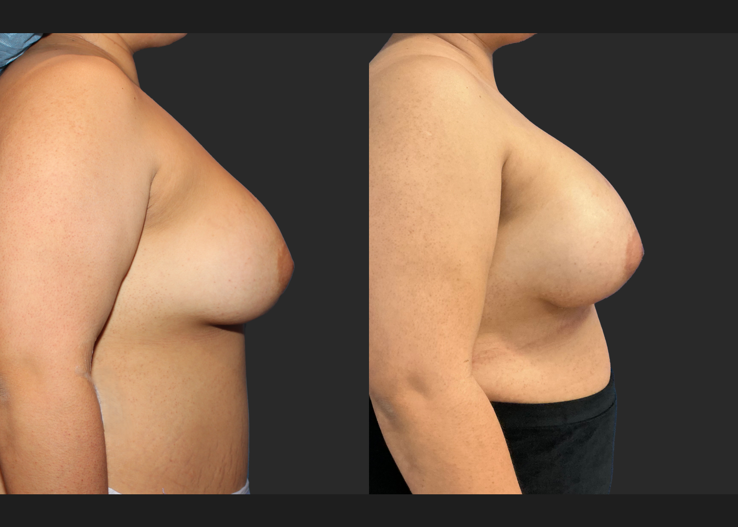 Remove replace delated saline implants before after- right
