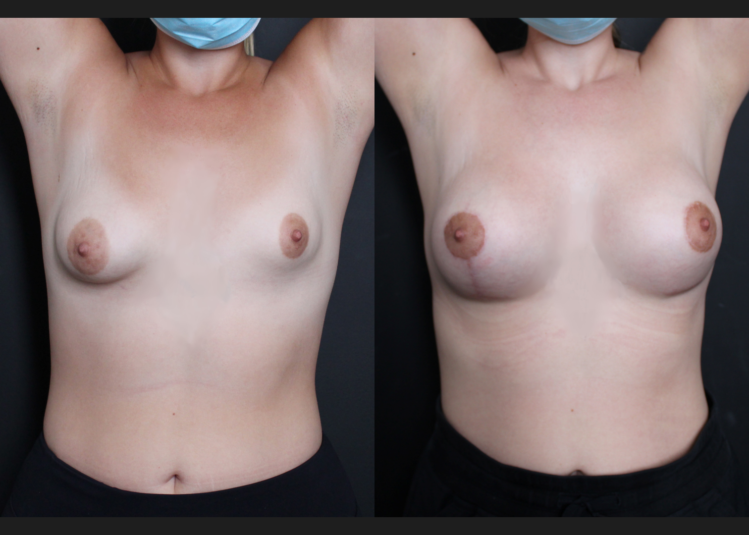 Tuberous asymmetry breast correction augmentation mastopexy lollipop donut lift SientraHSC+ smooth round high-profile silicone gel gummy bear implants subfascial before after-front up