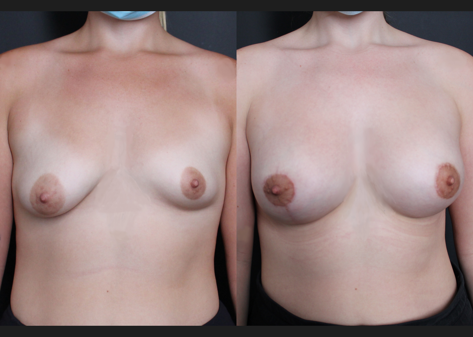 Tuberous asymmetry breast correction augmentation mastopexy lollipop donut lift SientraHSC+ smooth round high-profile silicone gel gummy bear implants subfascial before after-front