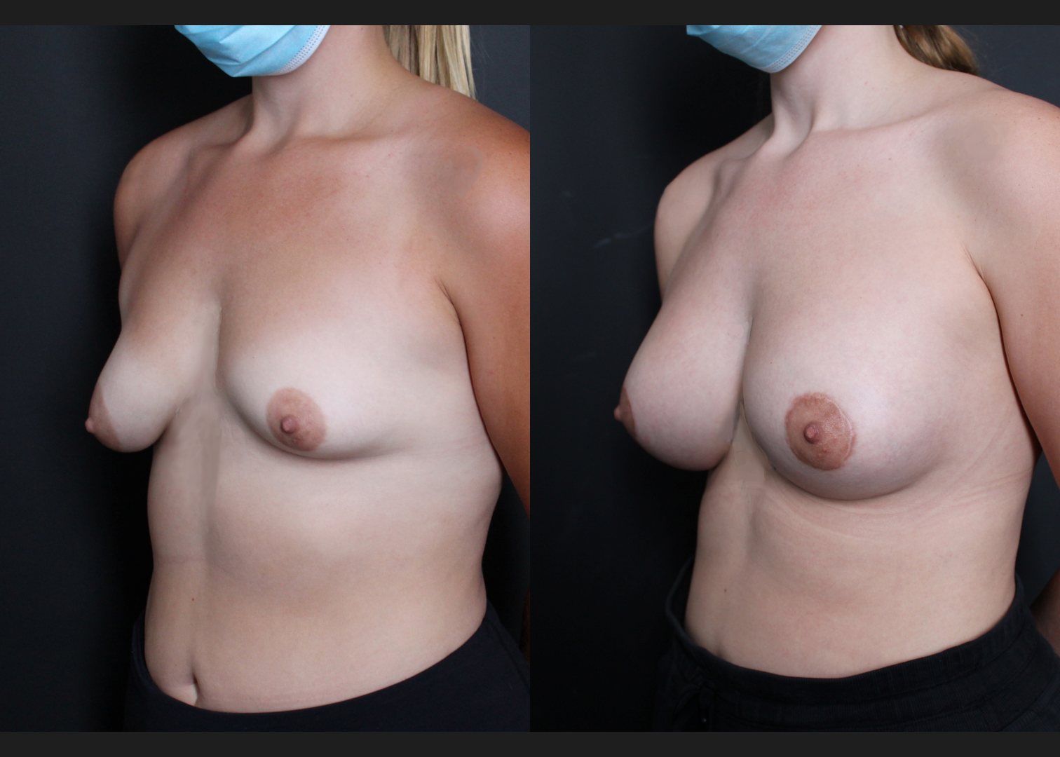 Tuberous asymmetry breast correction augmentation mastopexy lollipop donut lift SientraHSC+ smooth round high-profile silicone gel gummy bear implants subfascial before after-left oblique