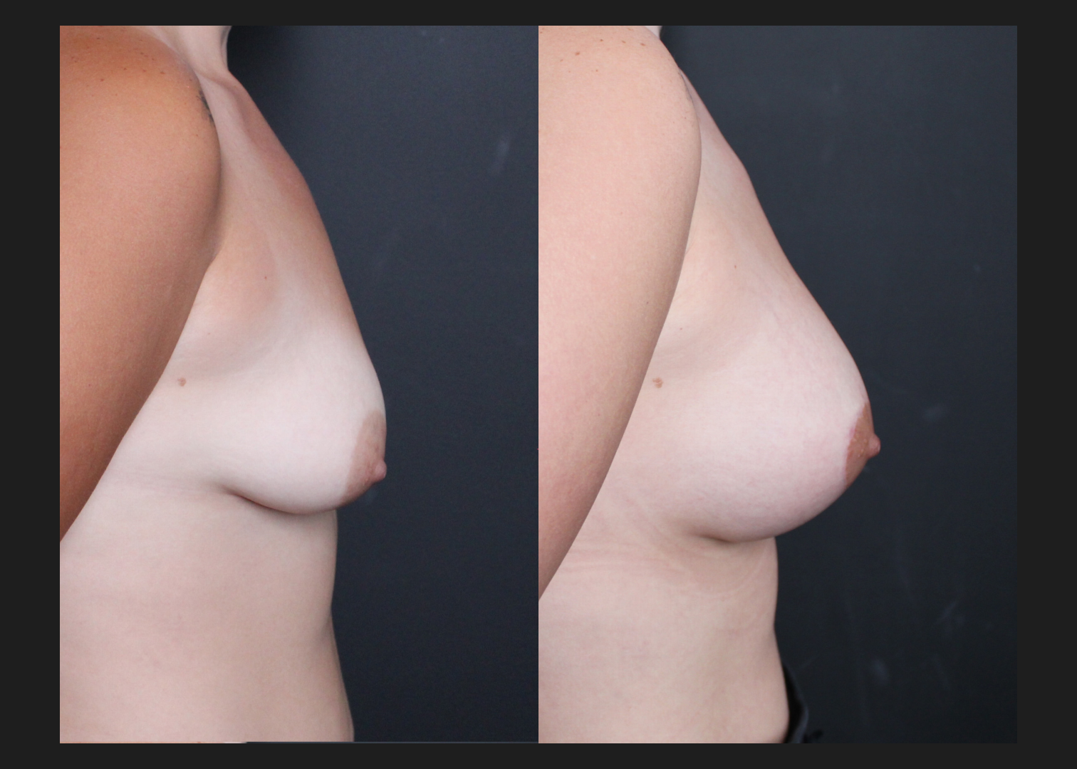 Tuberous asymmetry breast correction augmentation mastopexy lollipop donut lift SientraHSC+ smooth round high-profile silicone gel gummy bear implants subfascial before after-right 2