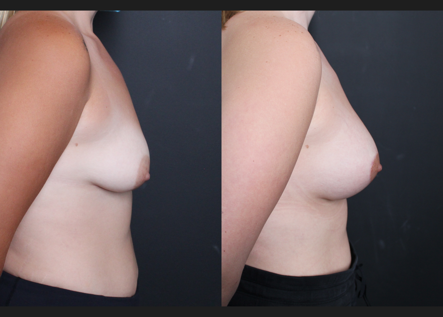 Tuberous asymmetry breast correction augmentation mastopexy lollipop donut lift SientraHSC+ smooth round high-profile silicone gel gummy bear implants subfascial before after-right